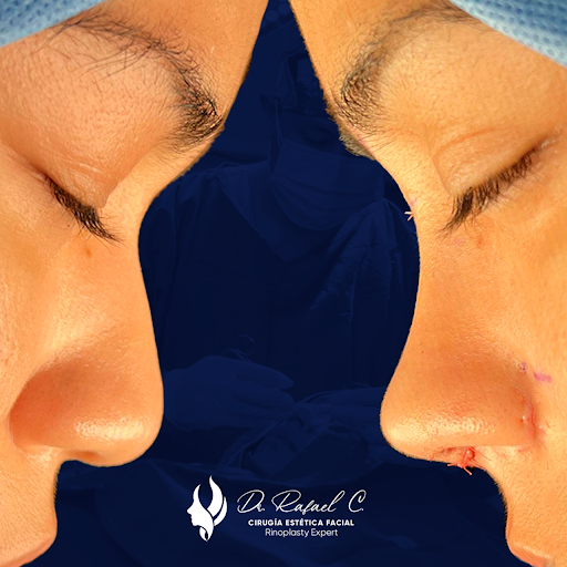 Dr. Rafael Carrera - Rinoplastia y Cirugía Estética Facial